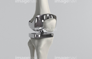 インプラント 人工関節 イラスト の画像素材 医療 イラスト Cgのイラスト素材ならイメージナビ