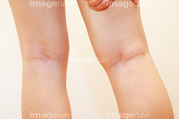 膝裏 の画像素材 病気 体調管理 人物の写真素材ならイメージナビ