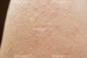 皮膚病 痛み の画像素材 外国人 人物の写真素材ならイメージナビ