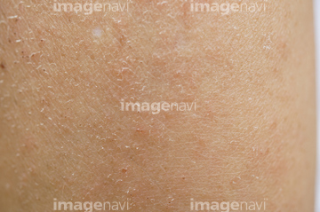 汗疹 の画像素材 体のパーツ 人物の写真素材ならイメージナビ