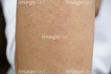 汗疹 の画像素材 体のパーツ 人物の写真素材ならイメージナビ