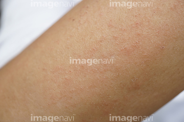 汗疹 の画像素材 体のパーツ 人物の写真素材ならイメージナビ