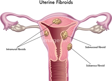 生殖器 女性 子宮 の画像素材 医療 福祉の写真素材ならイメージナビ