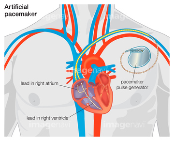 心臓ペースメーカー の画像素材 医療 福祉の写真素材ならイメージナビ