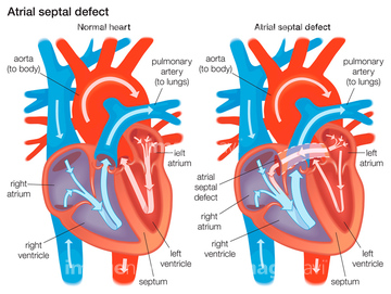インプラント 人工心臓 イラスト の画像素材 医療 イラスト Cgのイラスト素材ならイメージナビ