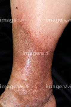 慢性静脈不全症 の画像素材 写真素材ならイメージナビ