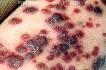カポジ肉腫 の画像素材 科学 テクノロジーの写真素材ならイメージナビ