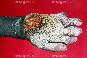 カポジ肉腫 の画像素材 科学 テクノロジーの写真素材ならイメージナビ