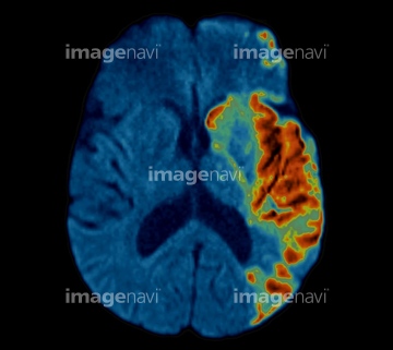 大脳基底核 苦しみ の画像素材 医療 イラスト Cgの写真素材ならイメージナビ